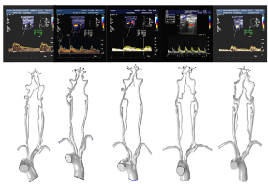 Fluid Dynamics Simulation and the Clinical Risk Alert of Cardiovascular Disease